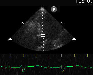 PW doppler in LVOT