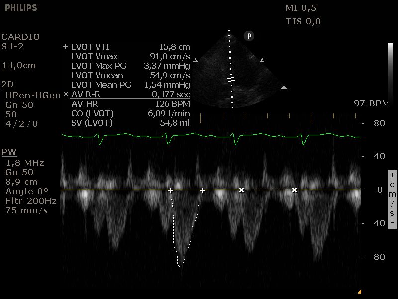 Bepaling cardiac output