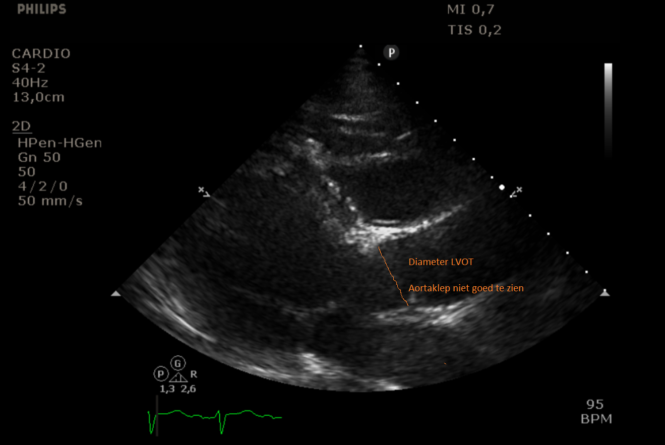 Meting diameter LVOT