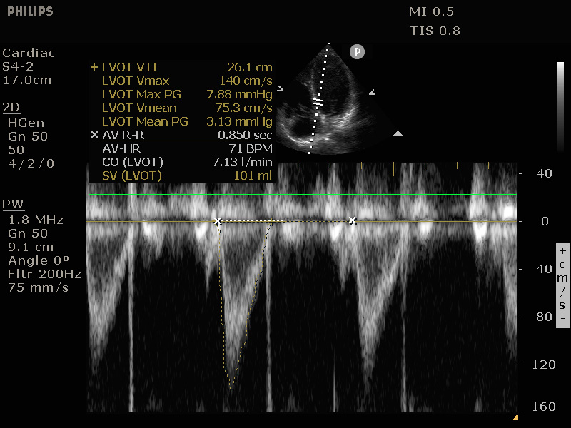 Bepaling cardiac output