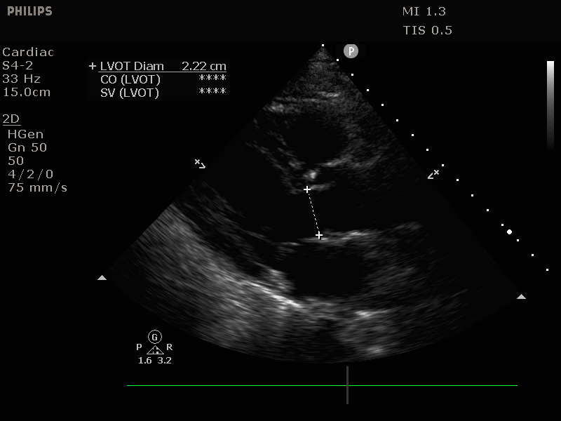 Meting diameter LVOT