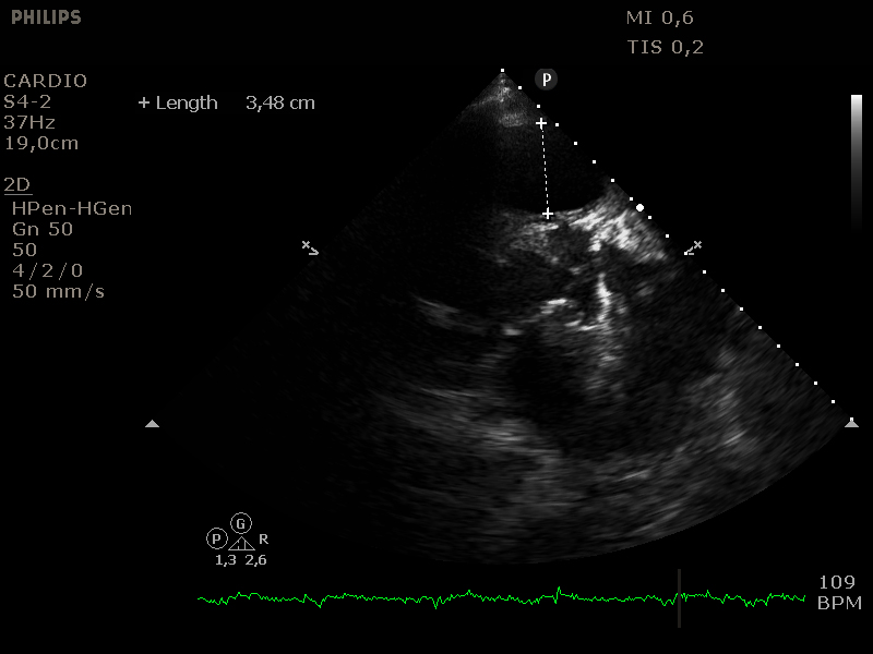 Rechter ventrikel outflow tract