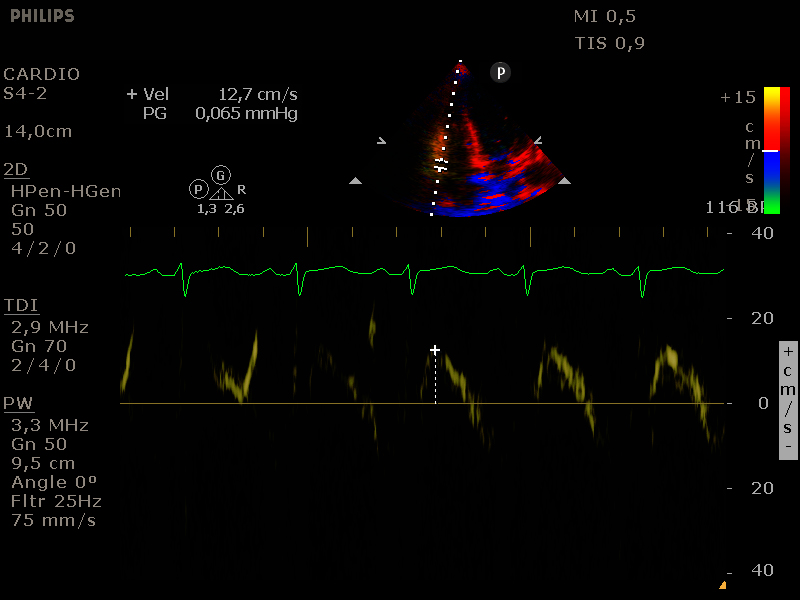 S prime tricuspidalisklep