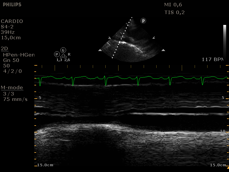 vena cava inferior in M-mode